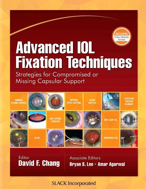 Portada del libro 9781630915810 Advanced IOL Fixation Techniques. Strategies for Compromised or Missing Capsular Support