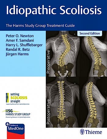 Portada del libro 9781684200559 Idiopathic Scoliosis. The Harms Study Group Treatment Guide