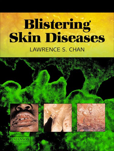 Portada del libro 9781840761757 Blistering Skin Diseases (Softcover)