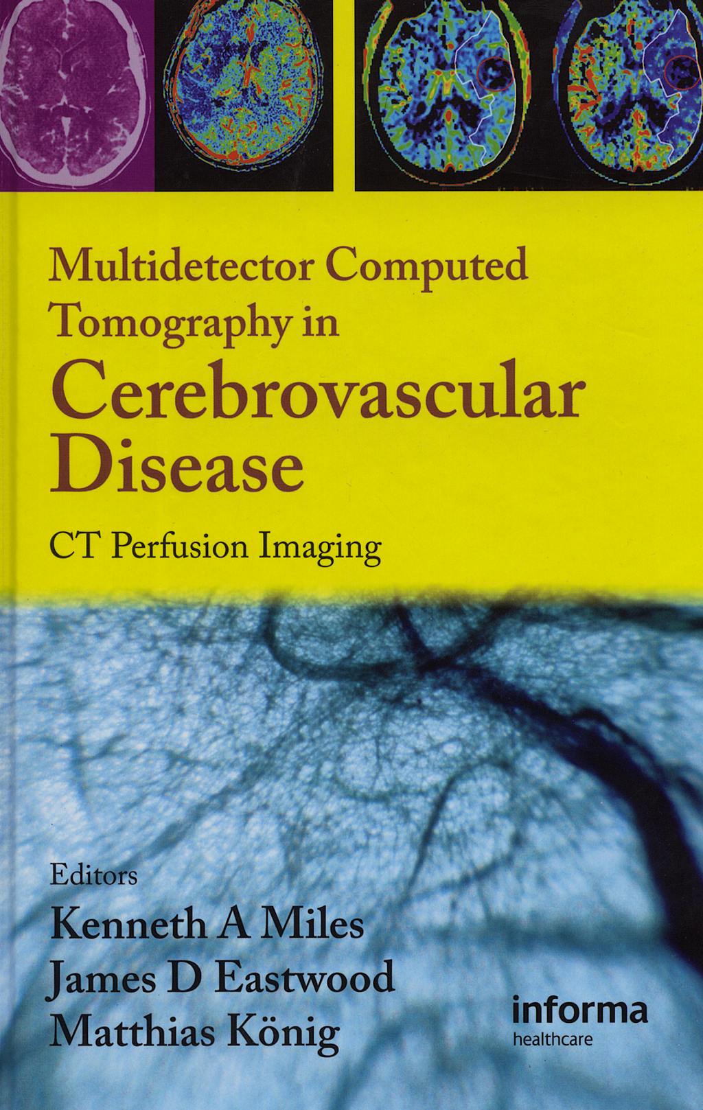 Portada del libro 9781842143155 Multidetector Computed Tomography in Cerebrovascular Disease