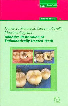 Portada del libro 9781850971351 Adhesive Restoration of Endodontically Treated Teeth