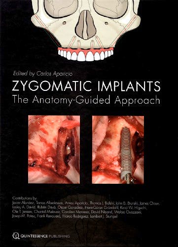 Portada del libro 9781850972259 Zygomatic Implants. The Anatomy Guided Approach