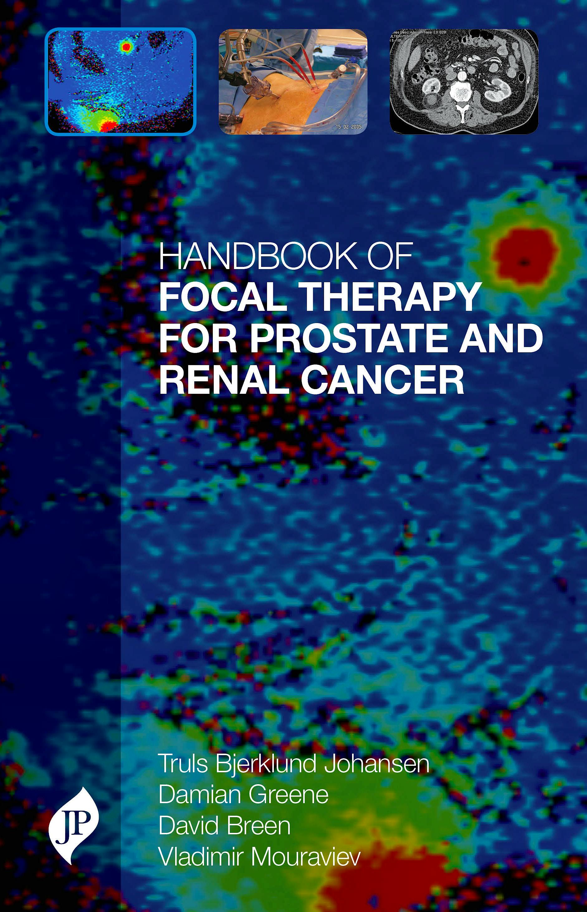 Portada del libro 9781909836112 Handbook of Focal Therapy for Prostate and Renal Cancer