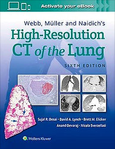Webb, Muller and Naidich's High-Resolution CT of the Lung