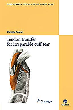 Portada del libro 9782817800486 Tendon Transfer for Irreparable Cuff Tear (Collection Geco, Vol. 1)