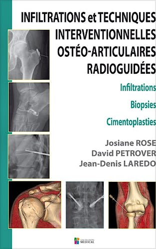 Portada del libro 9782840237464 Infiltrations Et Techniques Interventionnelles Osteo-Articulaires Radioguidees