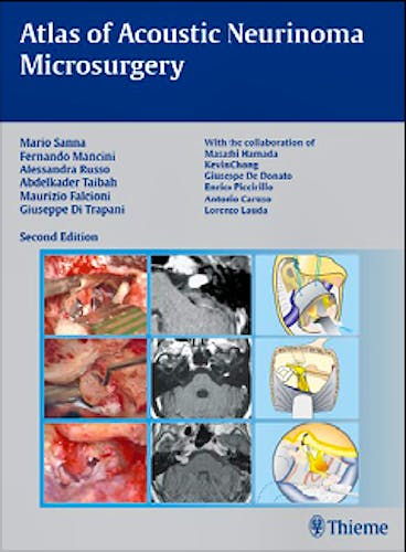 Portada del libro 9783131102829 Atlas of Acoustic Neurinoma Microsurgery