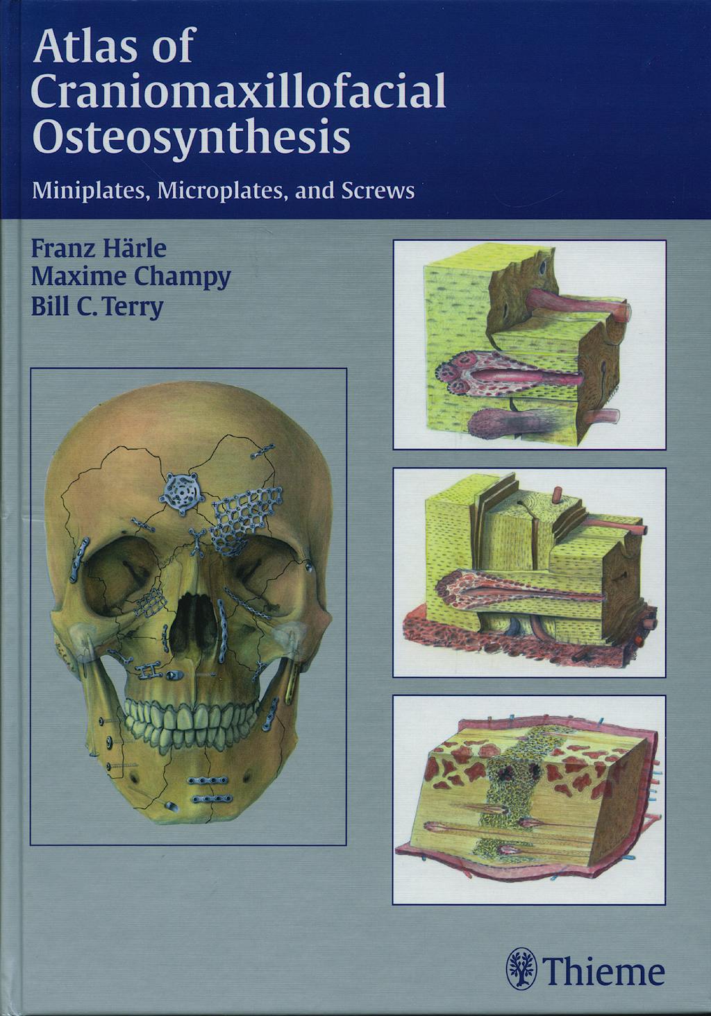 Craniomaxillofacial osteosynthesis 08 picture