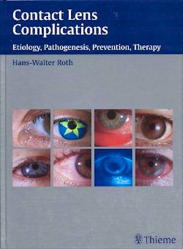 Portada del libro 9783131277916 Contact Lens Complications: Etiology, Pathogenesis