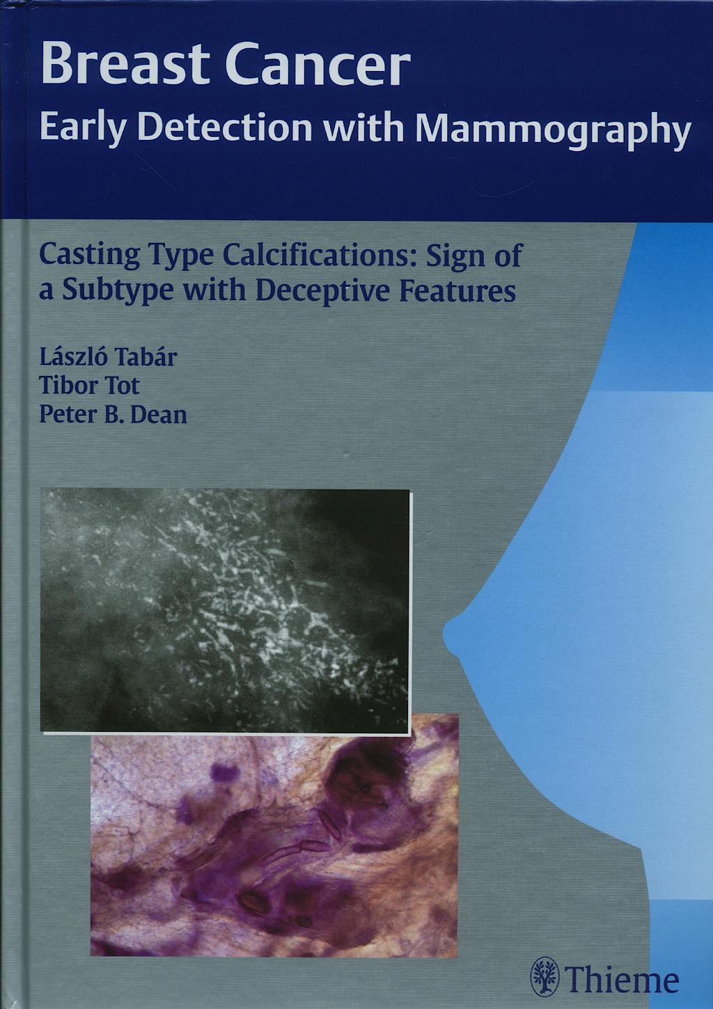Portada del libro 9783131353917 Breast Cancer. Early Detection with Mammography. Casting Type Calcifications: Sign of a Subtype with Deceptive Features.