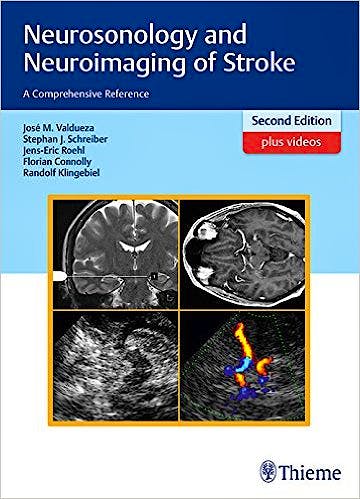 Portada del libro 9783131418722 Neurosonology and Neuroimaging of Stroke. A Comprehensive Reference + Videos