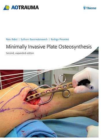 Portada del libro 9783131433923 Minimally Invasive Plate Osteosynthesis (Mipo)