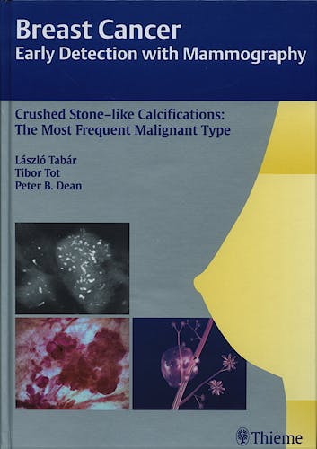 Portada del libro 9783131485311 Breast Cancer. Early Detection with Mammography. Crushed Stone-like Calcifications: The Most Frequent Malignant Type.