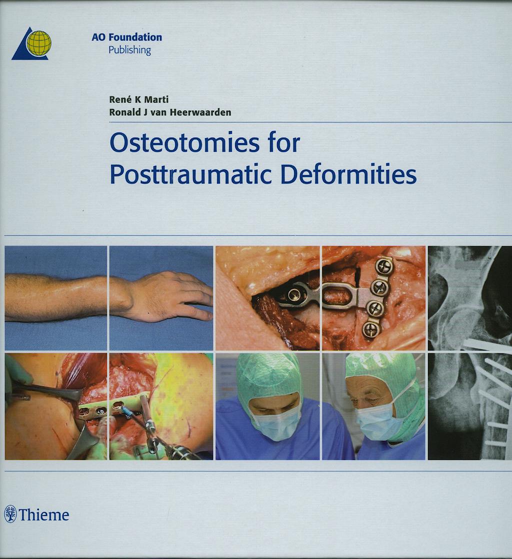 Portada del libro 9783131486714 Osteotomies for Posttraumatic Deformities