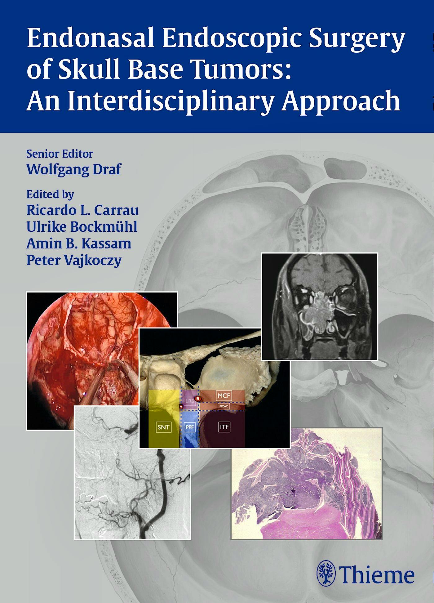 Portada del libro 9783131546715 Endonasal Endoscopic Surgery of Skull Base Tumors: An Interdisciplinary Approach