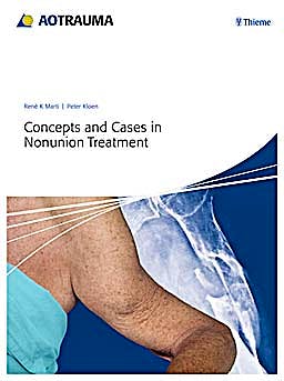 Portada del libro 9783131658517 Concepts and Cases in Nonunion Treatment