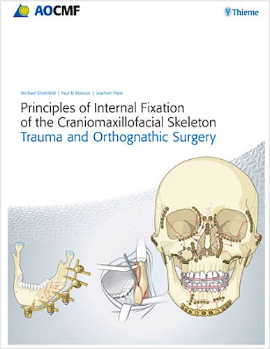 Portada del libro 9783131714817 Principles of Internal Fixation of the Craniomaxillofacial Skeleton