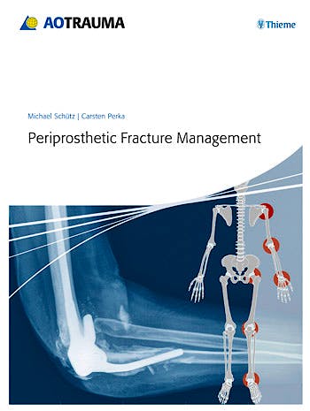 Portada del libro 9783131715111 Periprosthetic Fracture Management