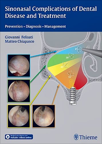 Portada del libro 9783131997012 Sinonasal Complications of Dental Disease and Treatment. Prevention, Diagnosis, Management