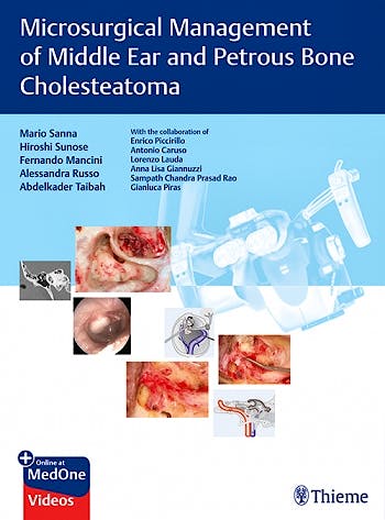 Portada del libro 9783132000056 Microsurgical Management of Middle Ear and Petrous Bone Cholesteatoma