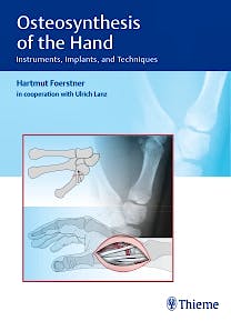Portada del libro 9783132038110 Osteosynthesis of the Hand. Instruments, Implants, and Techniques