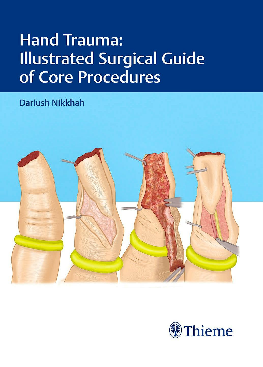 Portada del libro 9783132414266 Hand Trauma: Illustrated Surgical Guide of Core Procedures
