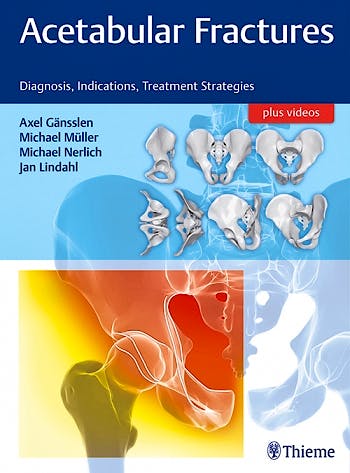 Portada del libro 9783132415607 Acetabular Fractures. Diagnosis, Indications, Treatment Strategies + Videos