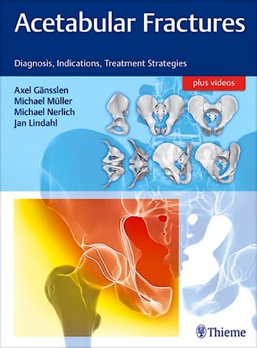 Portada del libro 9783132415607 Acetabular Fractures. Diagnosis, Indications, Treatment Strategies + Videos