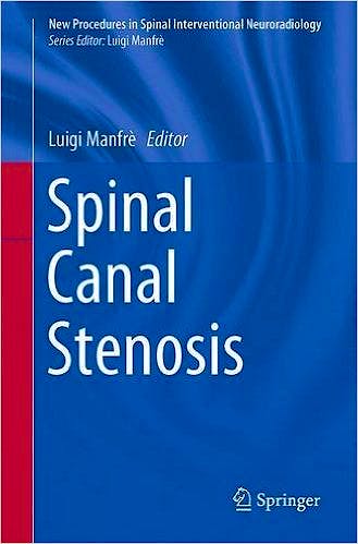 Portada del libro 9783319262680 Spinal Canal Stenosis (New Procedures in Spinal Interventional Neuroradiology)