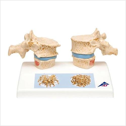 Modelo de Osteoporosis