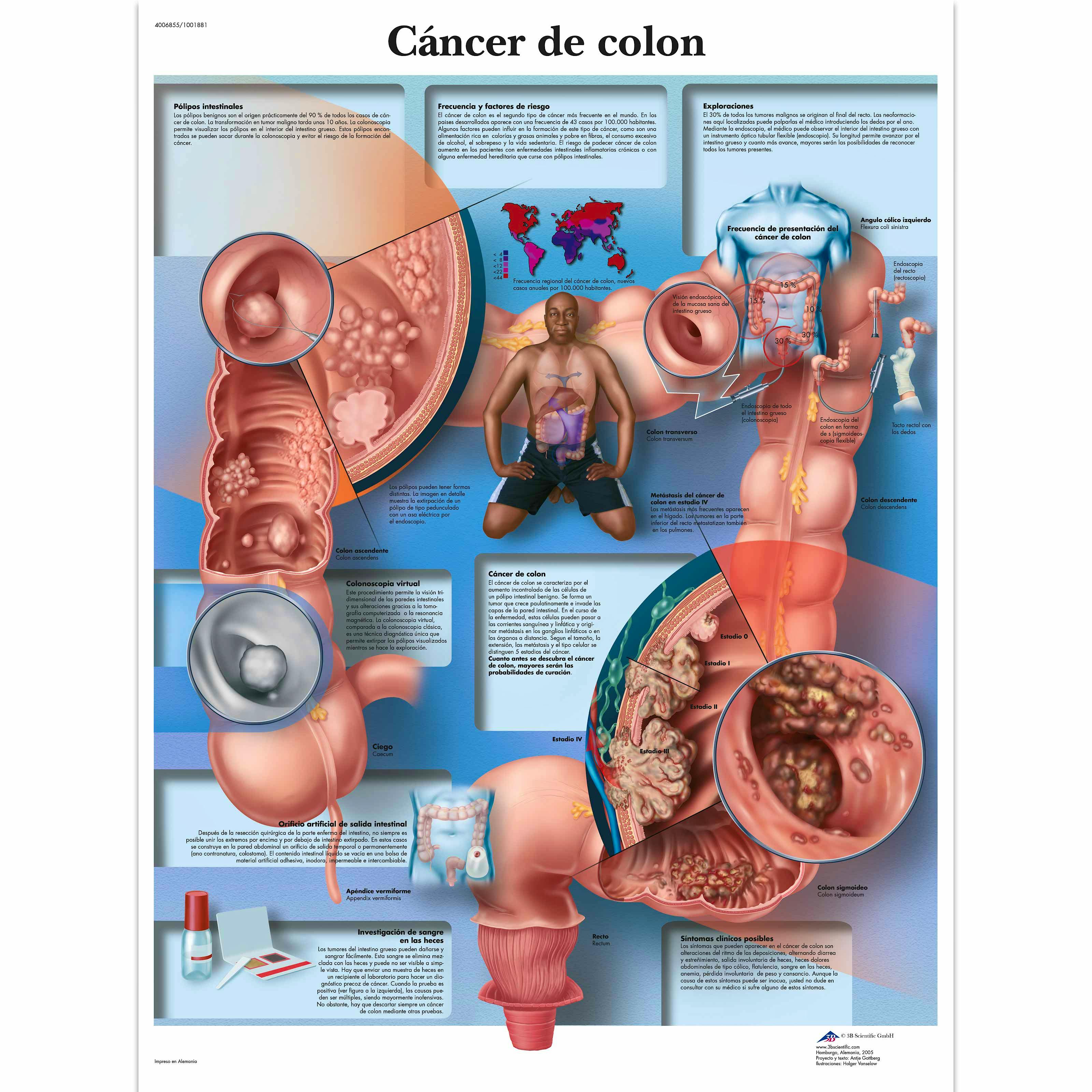 Lamina Cancer de Colon (formato 50 x 67 cm)
