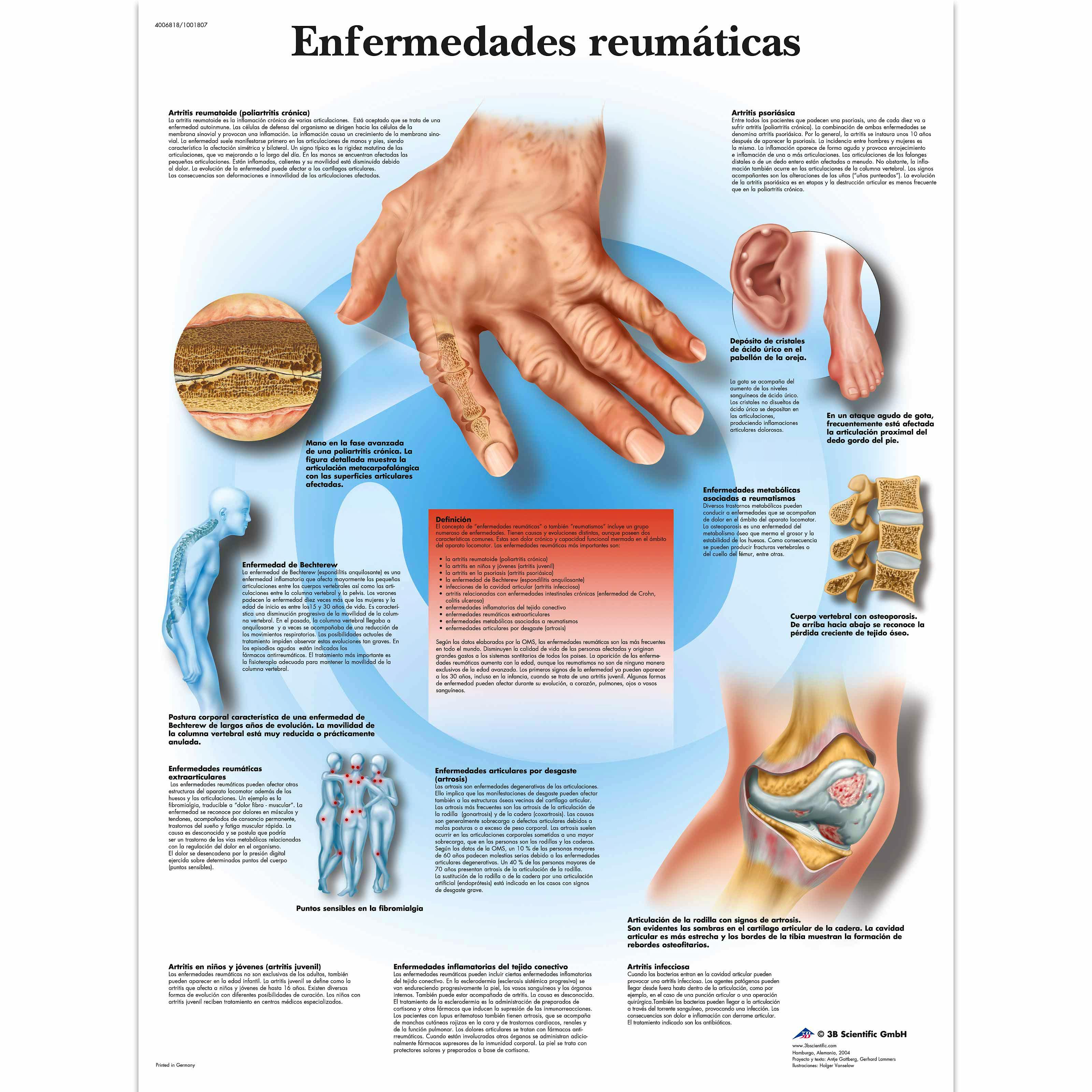 Lamina Enfermedades Reumaticas (formato 50 x 67 cm)
