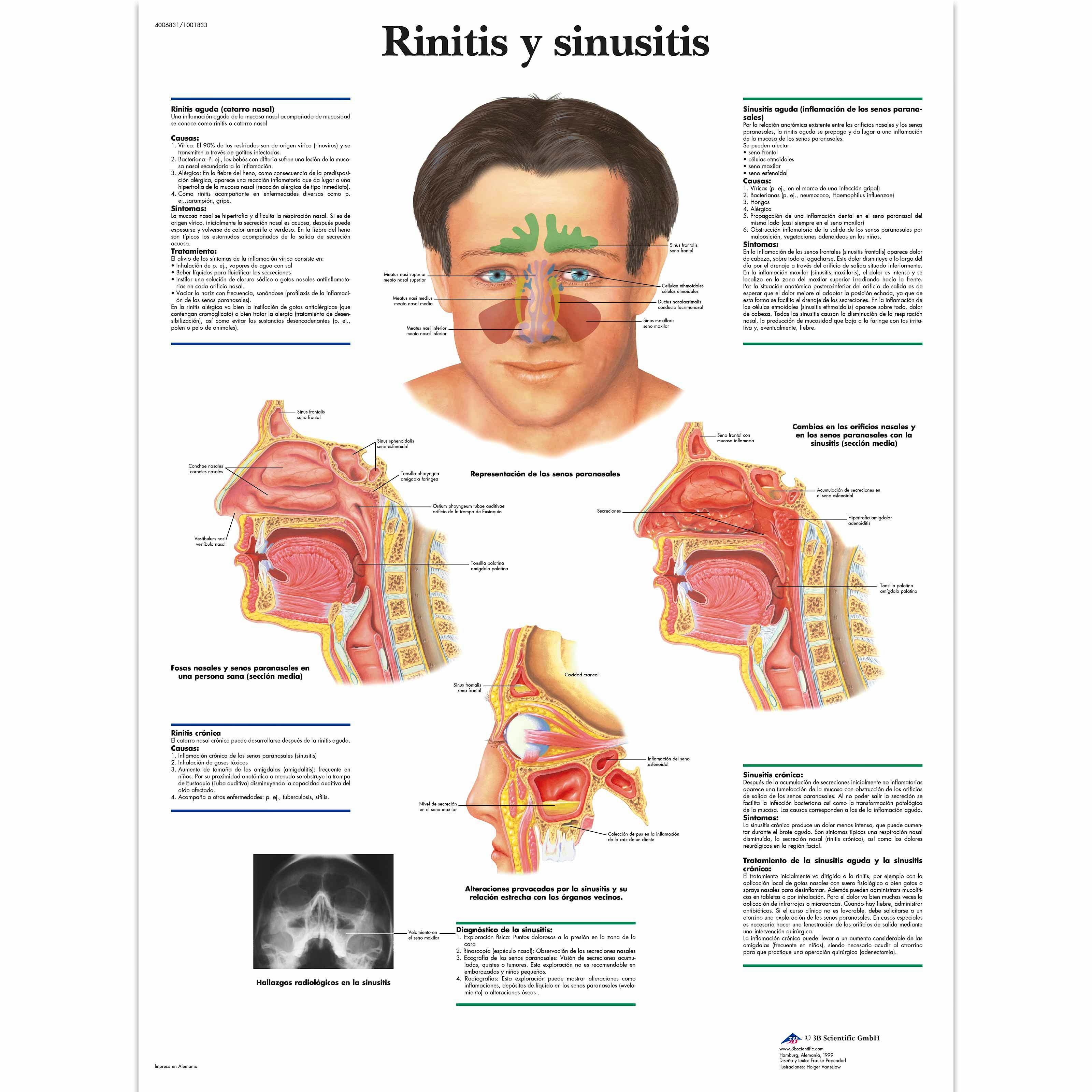 Lamina Rinitis y Sinusitis (formato 50 x 67 cm)