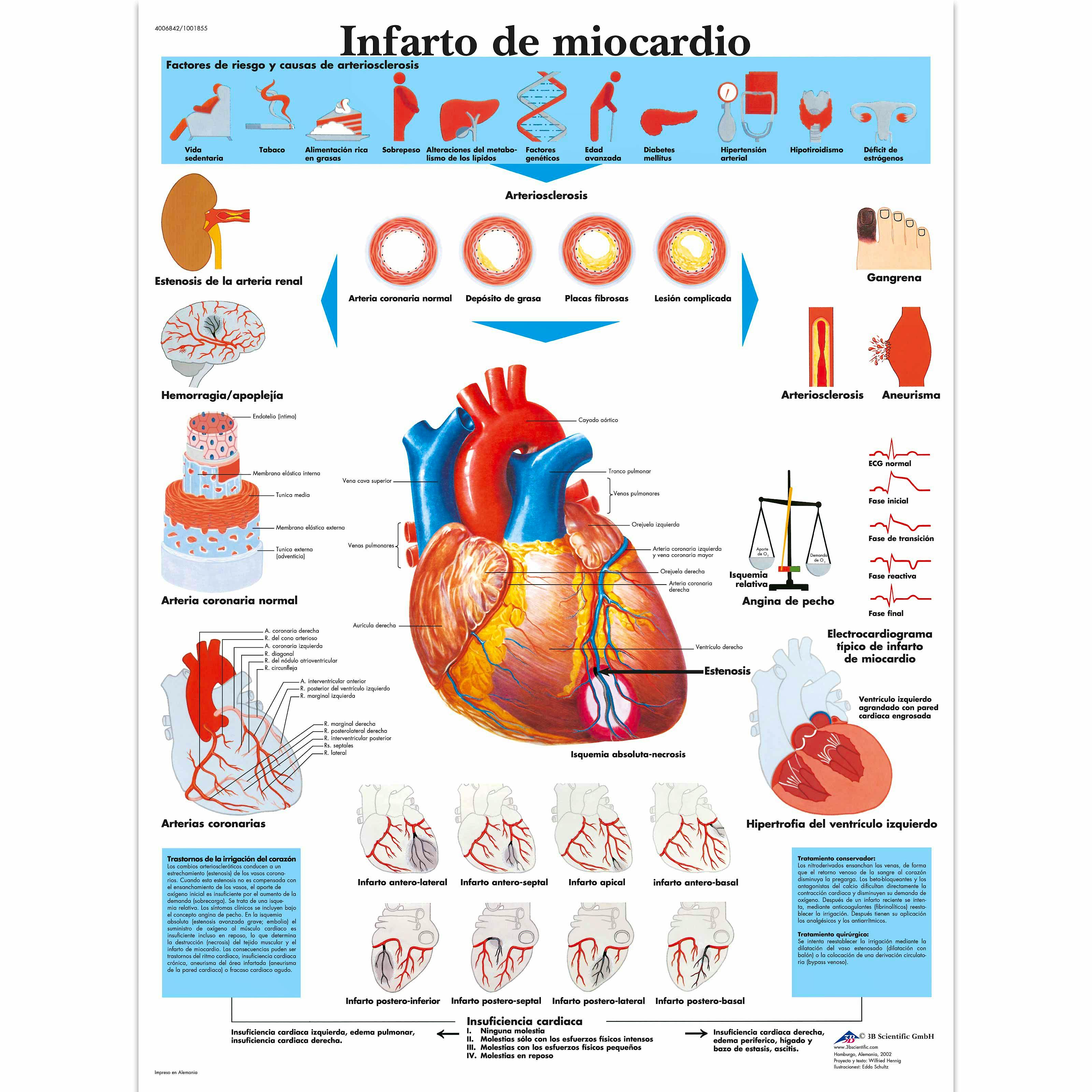 Lamina Infarto de Miocardio (formato 50 x 67 cm)