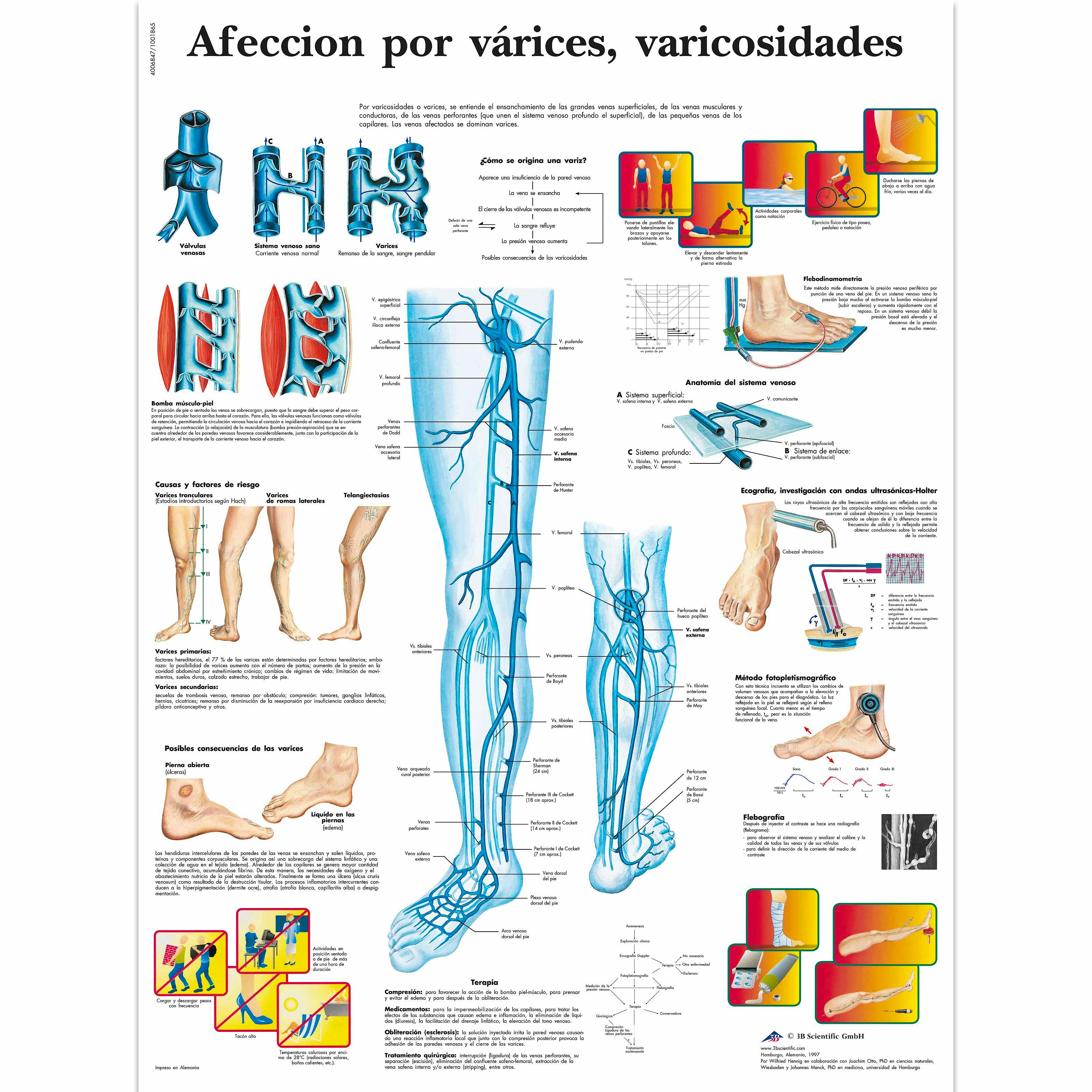 Lamina Afección por Varices, Varicosidades (formato 50 x 67 cm)