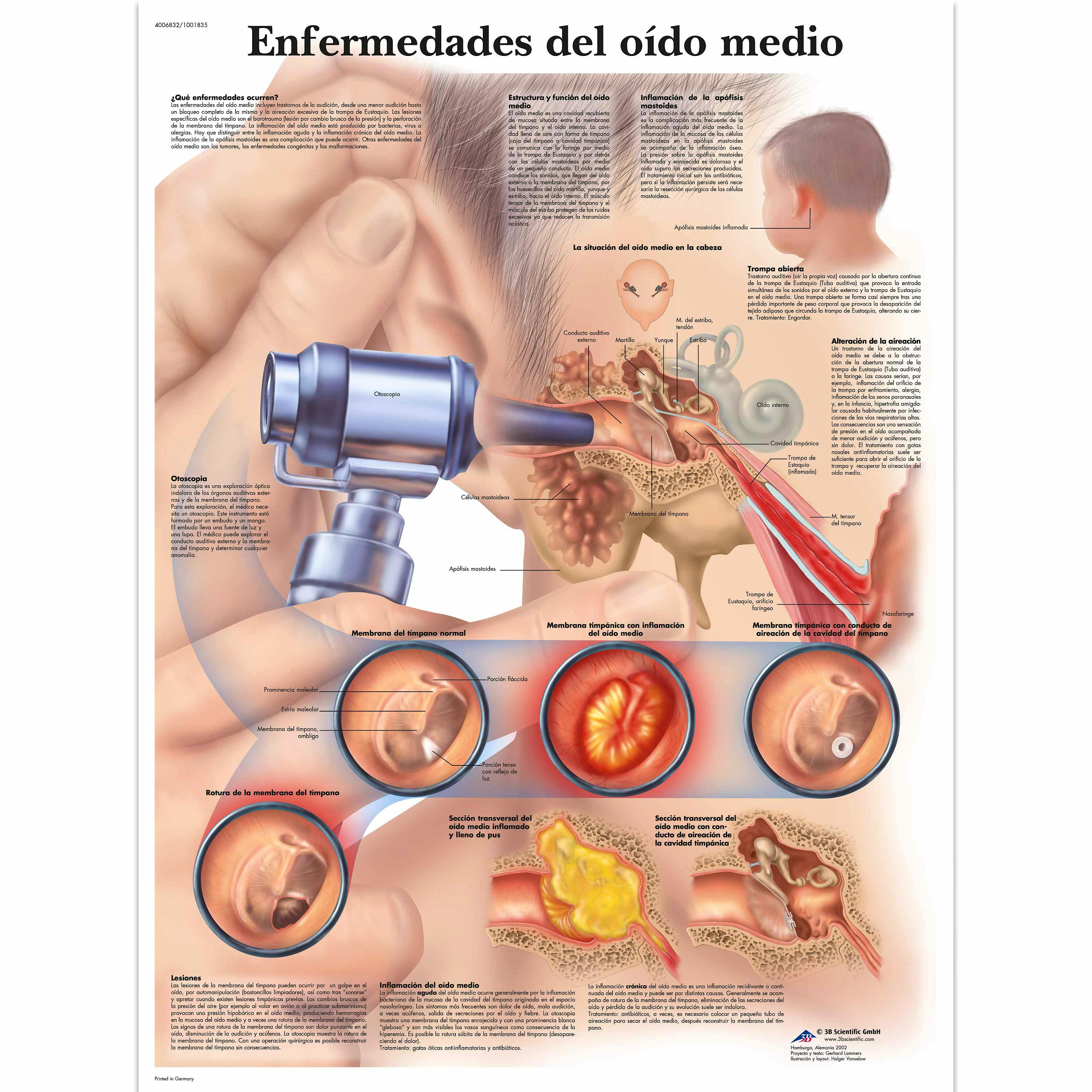 Lamina Enfermedades del Oido Medio (formato 50 x 67 cm)