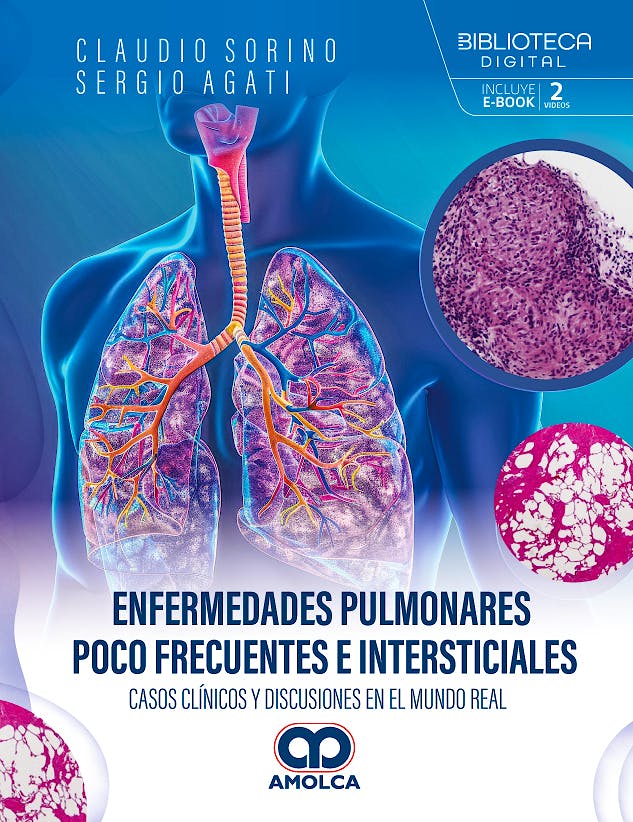 Portada del libro 9786287785458 Enfermedades Pulmonares Poco Frecuentes e Intersticiales