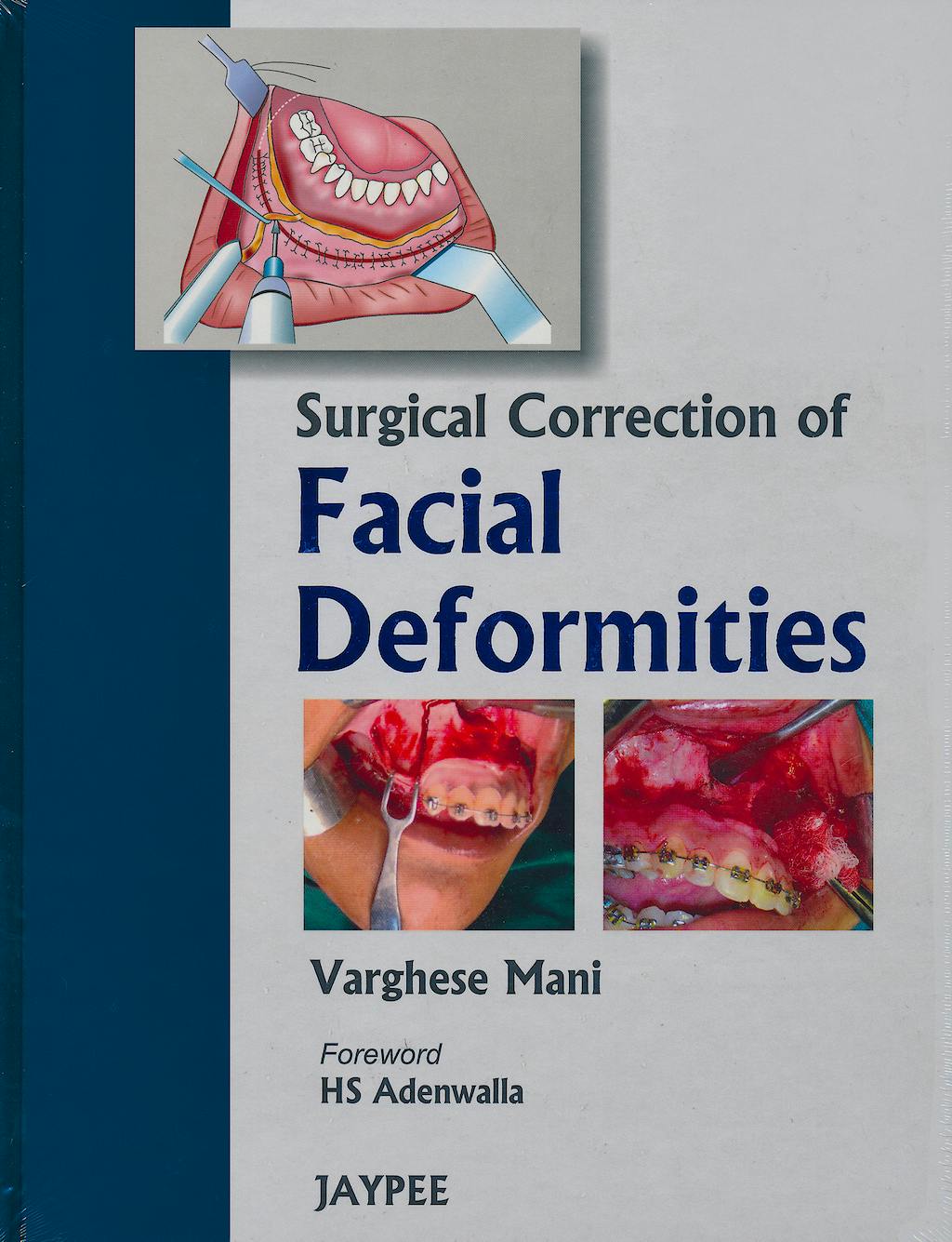 Portada del libro 9788184488791 Surgical Correction of Facial Deformities