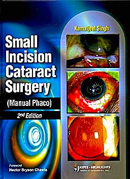 Portada del libro 9788184489804 Small Incision Cataract Surgery (Manual Phaco)