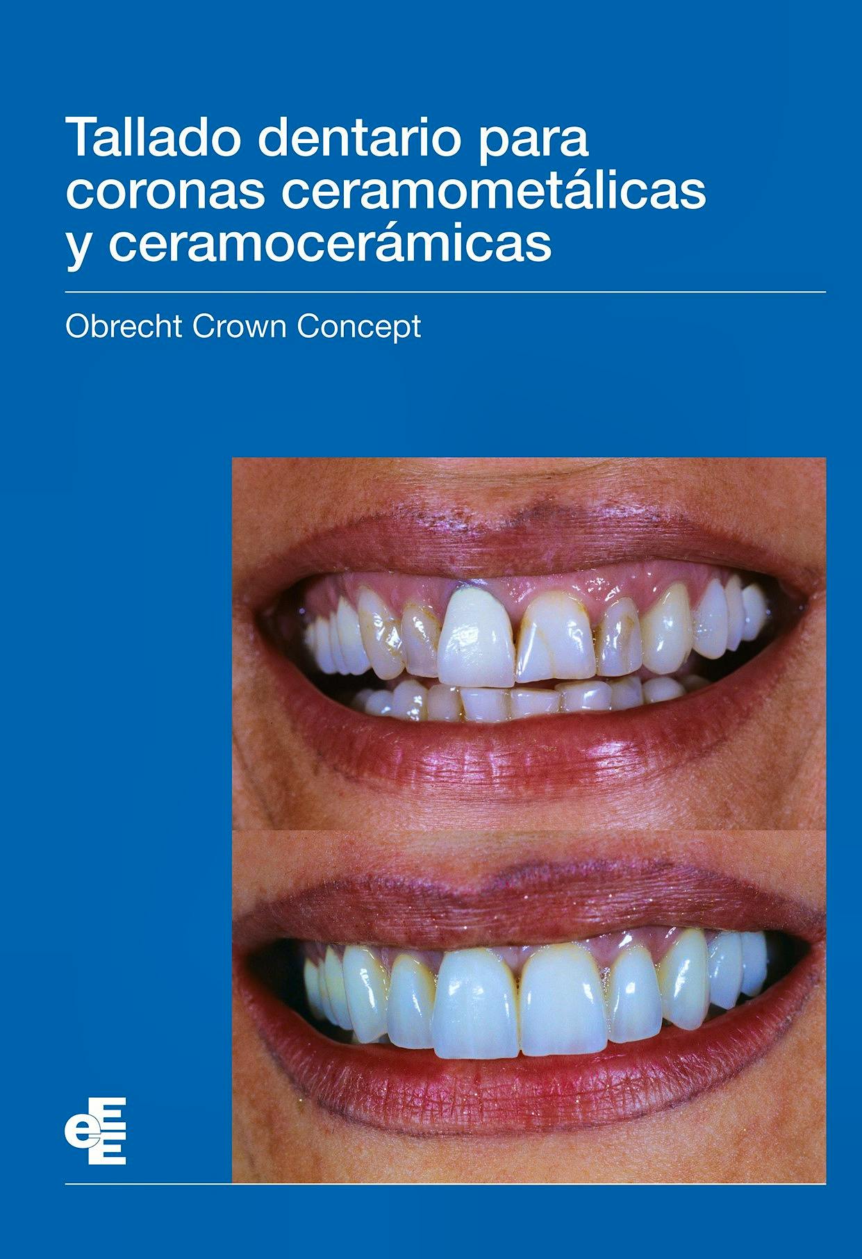 Portada del libro 9788412107869 Tallado Dentario para Coronas Ceramometálicas y Ceramocerámicas Obrecht Crown Concept