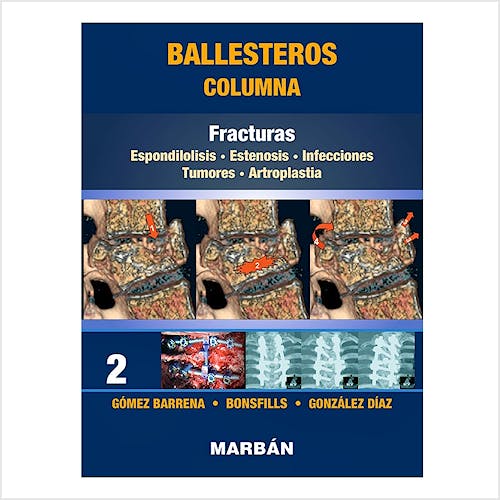 Portada del libro 9788418068485 Ballesteros Columna Tomo 2: Fracturas. Espondilolisis. Estenosis. Infecciones. Tumores. Artroplastia (Reimpresión 2021)