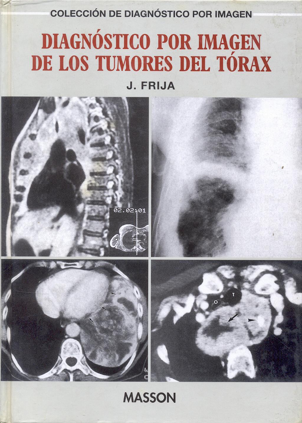 Portada del libro 9788445804117 Diagnostico por Imagen de los Tumores del Torax