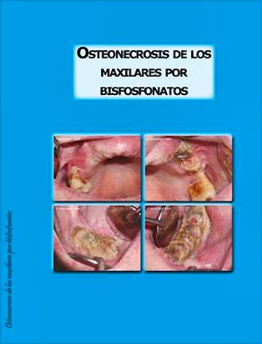 Portada del libro 9788461249510 Osteonecrosis de los Maxilares por Bisfosfonatos