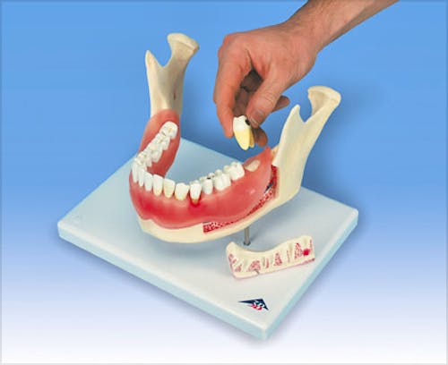 Afeccion Dental a 2 Aumentos de 21 Piezas
