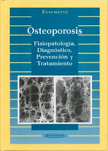 Portada del libro 9788479033736 Osteoporosis