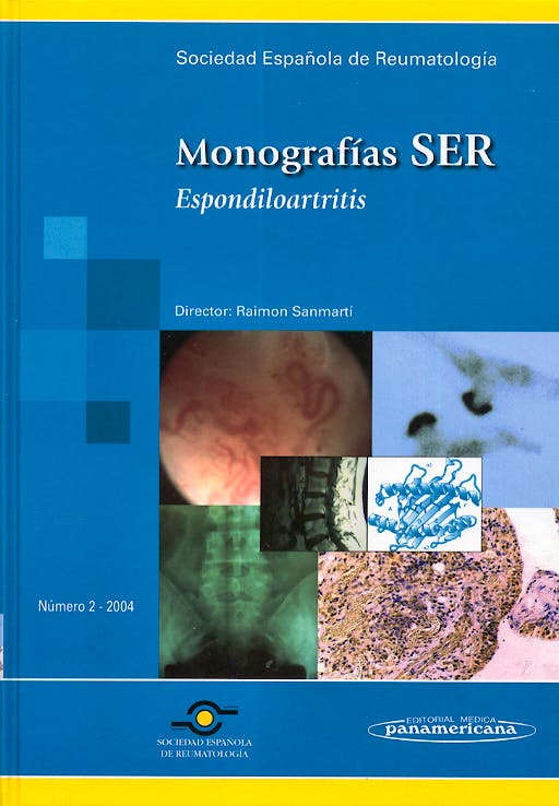 Portada del libro 9788479039059 Espondiloartritis. Monografias Ser