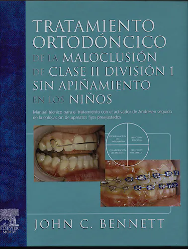 Portada del libro 9788480862233 Tratamiento Ortodóncico de la Maloclusión de Clase II División 1 sin Apiñamiento en los Niños