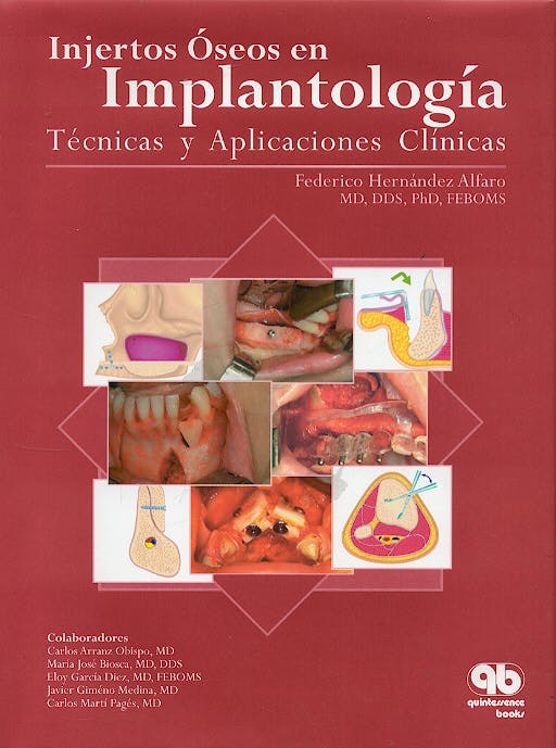 Portada del libro 9788489873346 Injertos Oseos en Implantologia. Tecnicas y Aplicaciones Clinicas