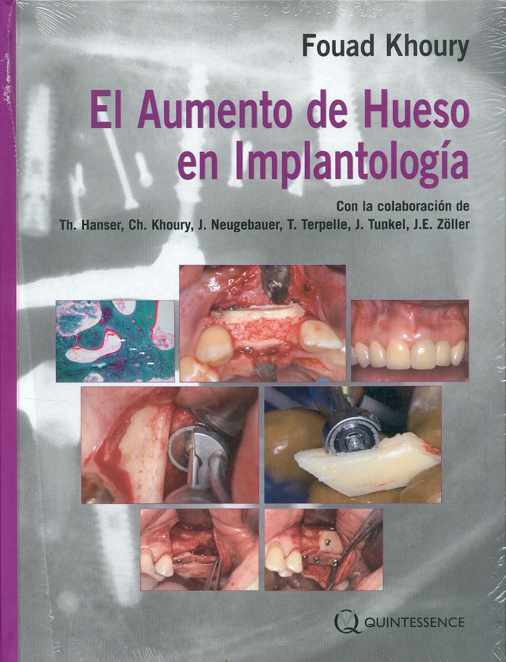 Portada del libro 9788489873445 El Aumento de Hueso en Implantología