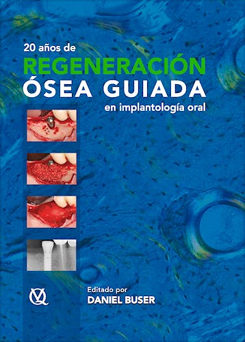 Portada del libro 9788489873490 20 Años de Regeneración Ósea Guiada en Implantología Oral